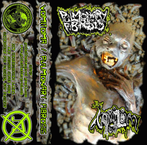 Pulmonary Fibrosis : Pulmonary Fibrosis - Vomitoma